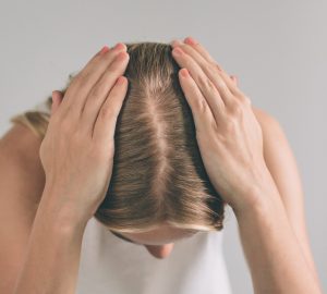 a woman with hair loss